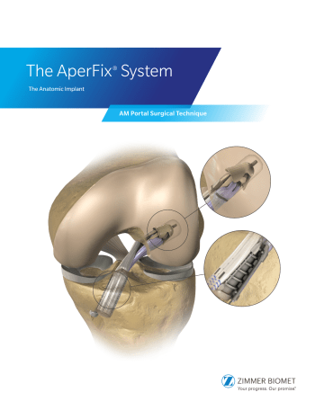 Zimmer AperFix II Tibial Sheath and Screw System Owner's Manual | Manualzz