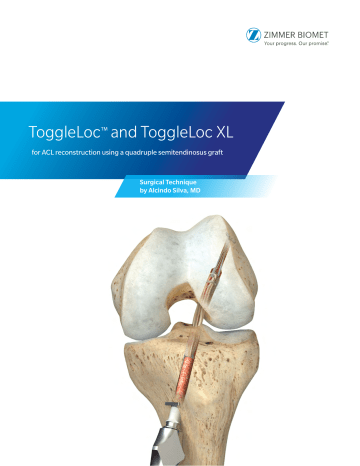 Zimmer ToggleLoc™ Device Technology Owner's Manual | Manualzz